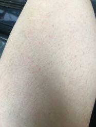 -薇兰专业脱毛连锁机构