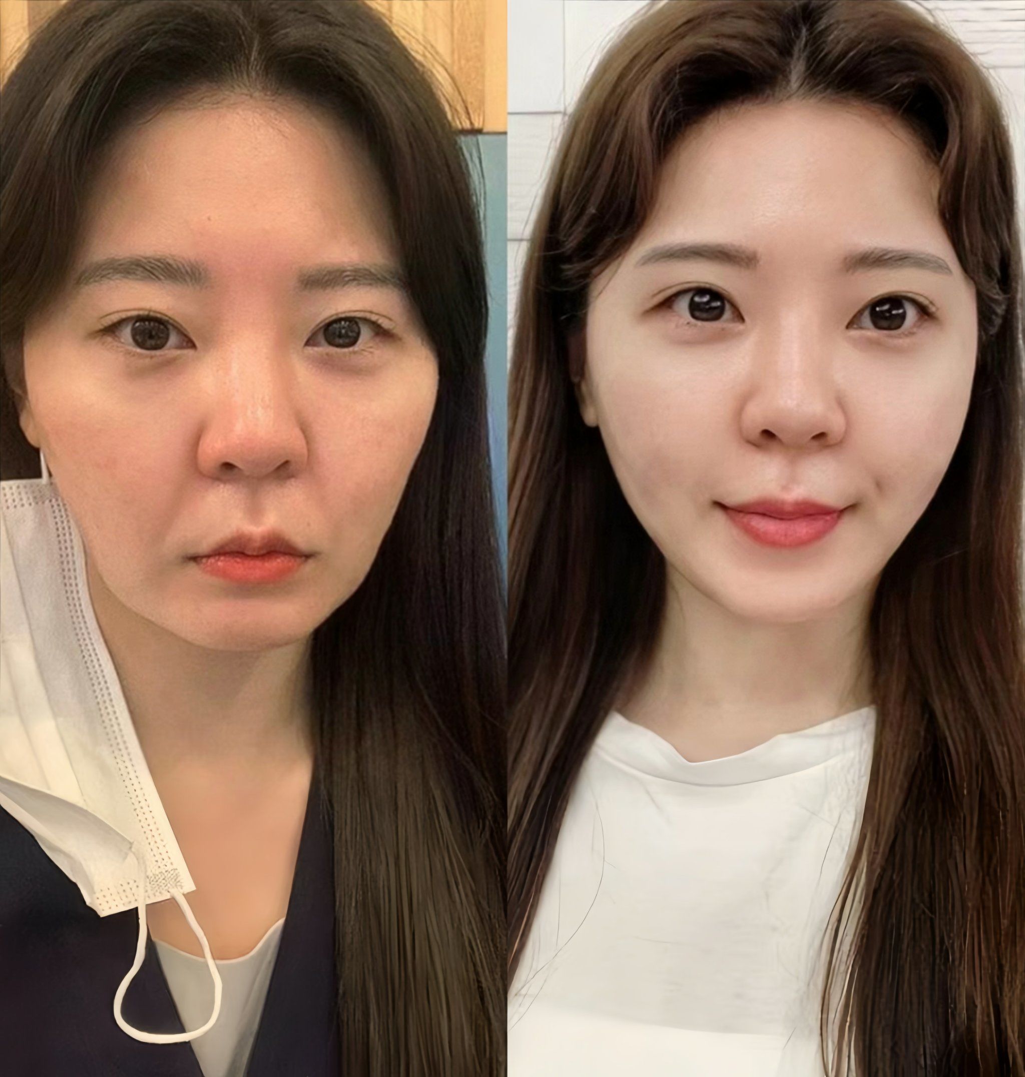 在泰州玻尿酸填充完苹果肌有一个月了