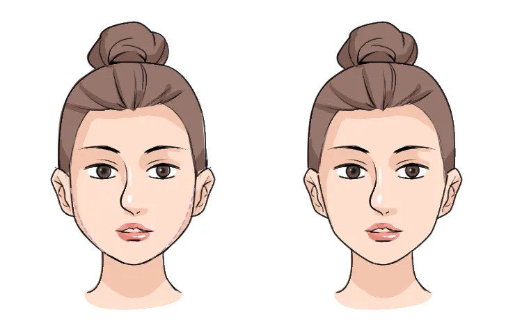 玻尿酸在合适量的情况下是不会让脸变僵的.