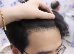 点击看大图 -大麦微针植发丨全国连锁