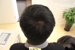 点击看大图 -大麦微针植发丨全国连锁