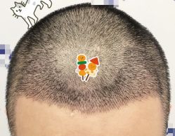 -大麦微针植发全国连锁