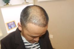 -大麦微针植发丨全国连锁