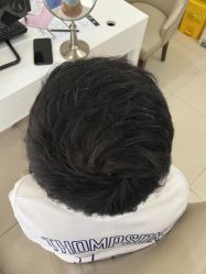 -大麦微针植发丨全国连锁