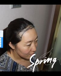 点击看大图 -大麦微针植发全国连锁