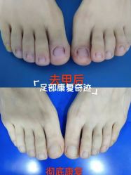 -德哥灰指甲脚气甲沟炎跖疣护理