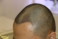 -大麦微针植发丨全国连锁