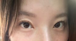 -爱莎扁平疣·汗管瘤·斑痣中心