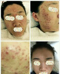 -美肤盾祛痘·问题肌头疗管理中心