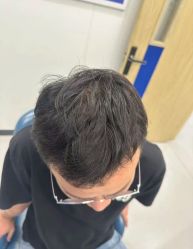-大麦微针植发全国连锁