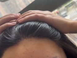 -碧莲盛·不剃发植发