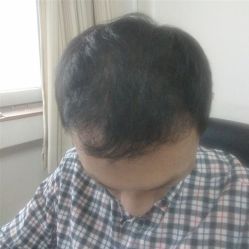 -碧莲盛·不剃发植发