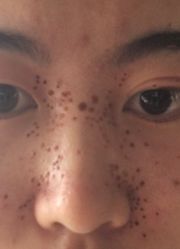 -爱莎扁平疣·汗管瘤·斑痣中心