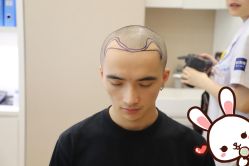 -大麦微针植发丨全国连锁