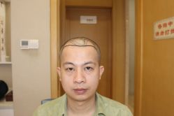点击看大图 -大麦微针植发丨全国连锁