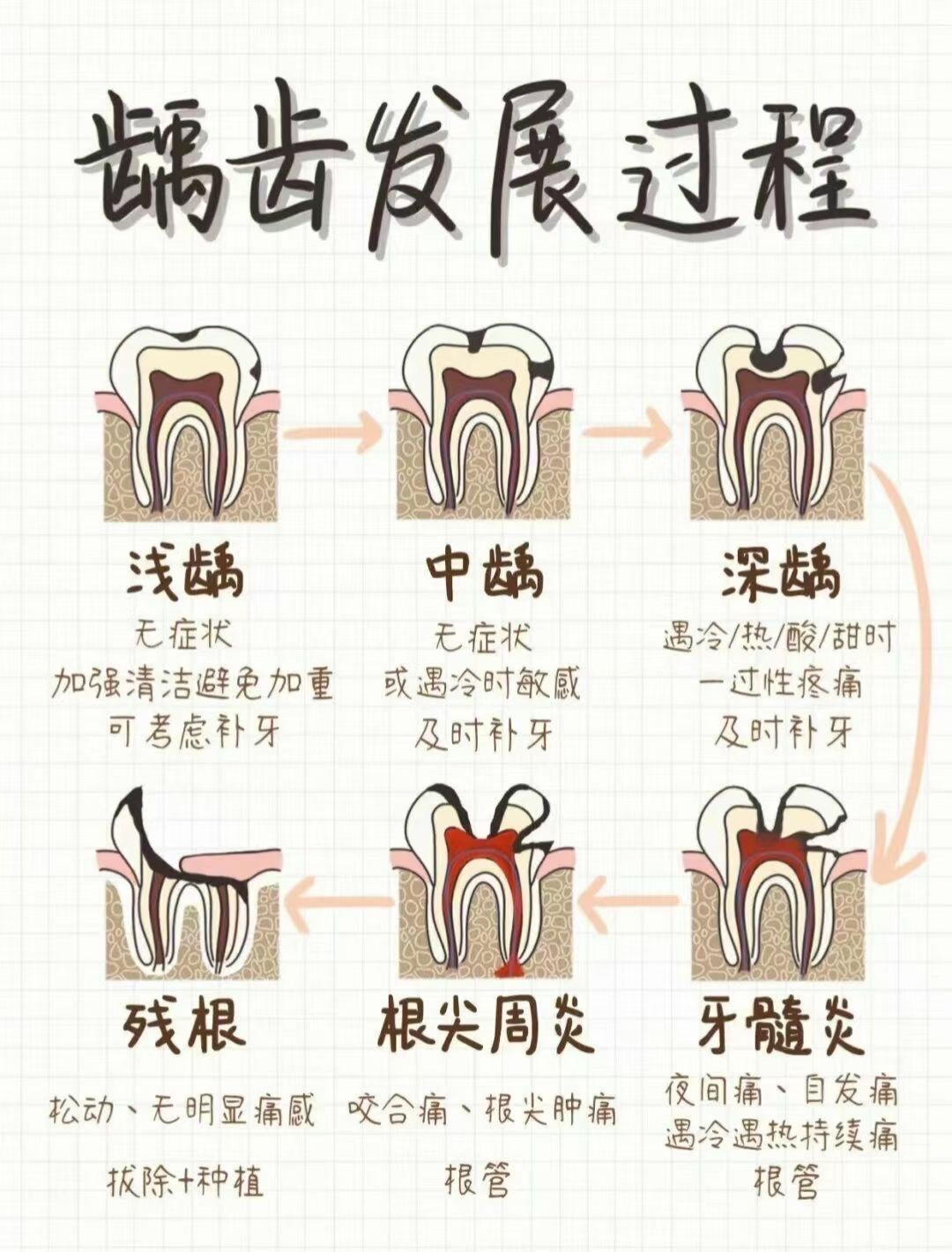 龋齿发展过程