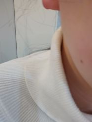 体验后-颜蕾医美黄金微针水光美肤玻尿酸抗衰中心
