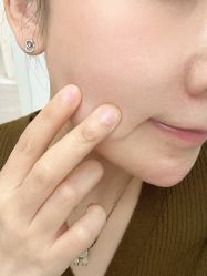 体验后-SKINIST丽铂医疗美容