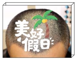 -大麦微针植发全国连锁