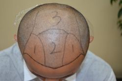 -大麦微针植发丨全国连锁