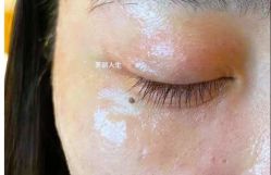 -爱莎扁平疣·汗管瘤·斑痣中心