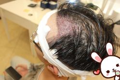 -大麦微针植发丨全国连锁