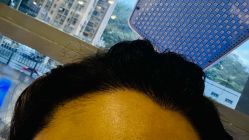 -碧莲盛·不剃发植发