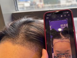 -碧莲盛·不剃发植发