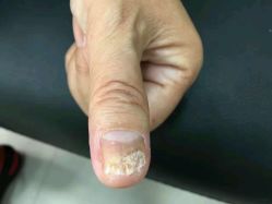 点击看大图 -德哥灰指甲脚气甲沟炎跖疣护理