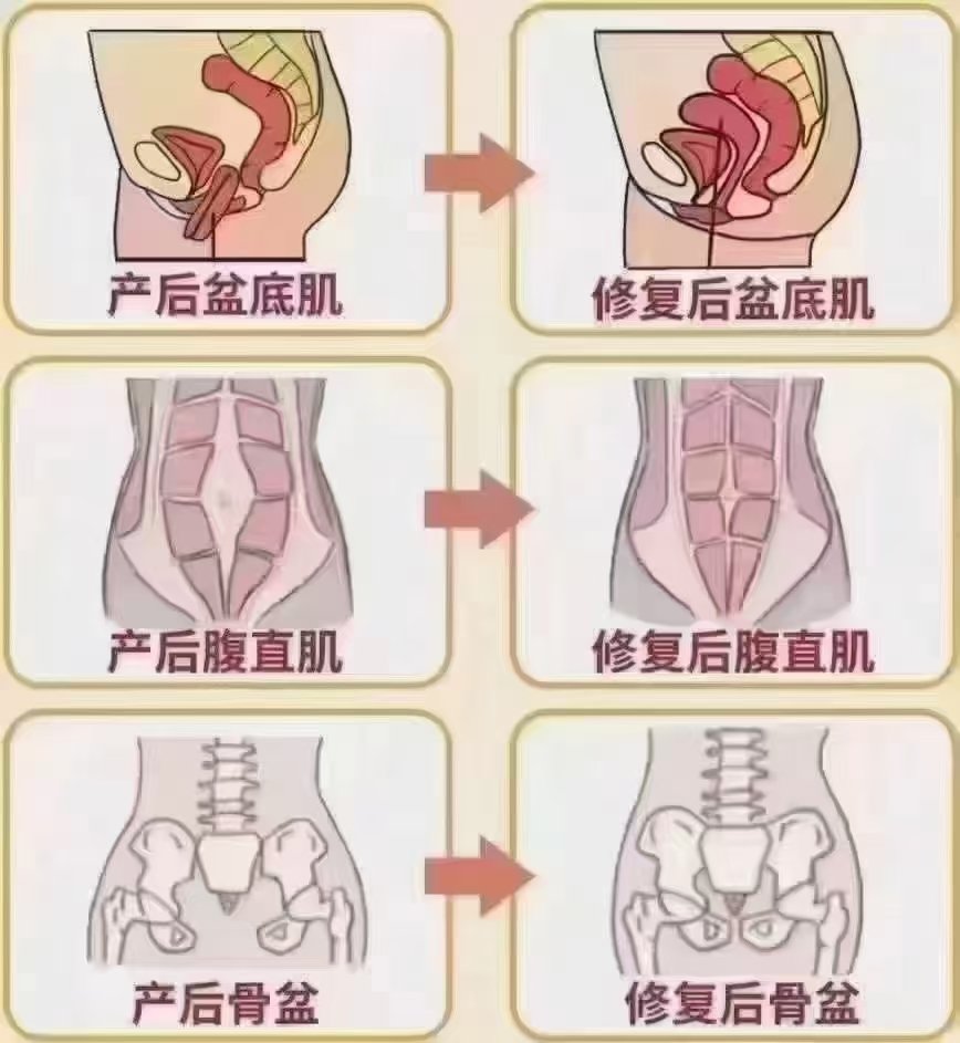 产后宫腔分离图片