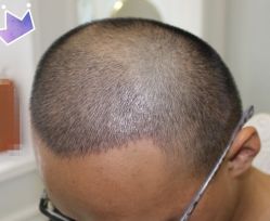 -大麦微针植发丨全国连锁