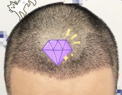 -大麦微针植发全国连锁