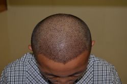 -大麦微针植发丨全国连锁