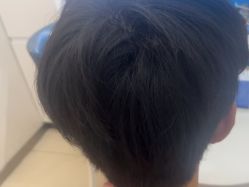 -大麦微针植发丨全国连锁