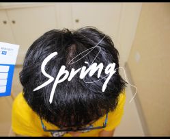 体验后-大麦微针植发全国连锁