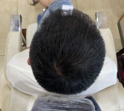 -大麦微针植发全国连锁
