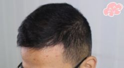 -大麦微针植发丨全国连锁