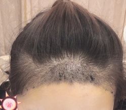 -大麦微针植发丨全国连锁