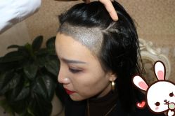 点击看大图 -大麦微针植发丨全国连锁