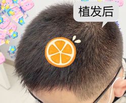 -大麦微针植发全国连锁