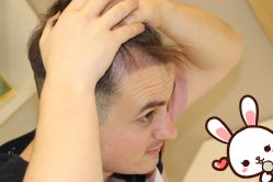 -大麦微针植发丨全国连锁