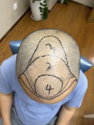 -大麦微针植发全国连锁