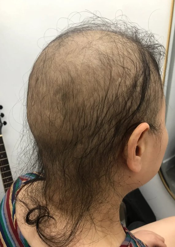放疗掉头发吗 大众点评