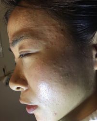 -美丽人生祛斑扁平疣汗管瘤中心