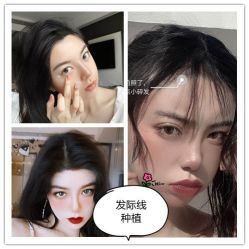 点击看大图 -碧莲盛·不剃发植发