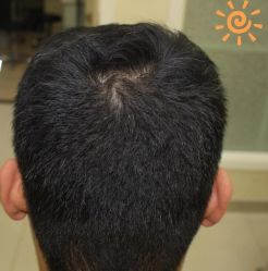 -大麦微针植发丨全国连锁