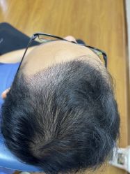 -大麦微针植发全国连锁