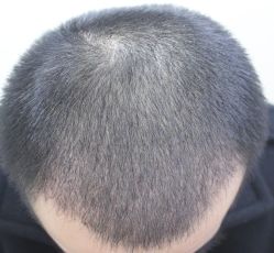 -大麦微针植发丨全国连锁