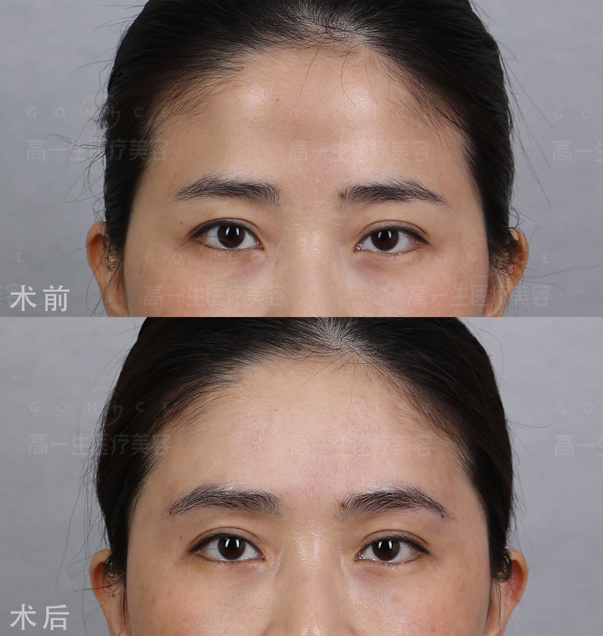 眉弓注射,玻尿酸打眉弓