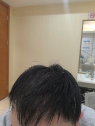 -碧莲盛·不剃发植发